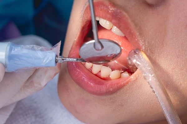 How A Professional Deep Teeth Cleaning Can Save Your Oral Health