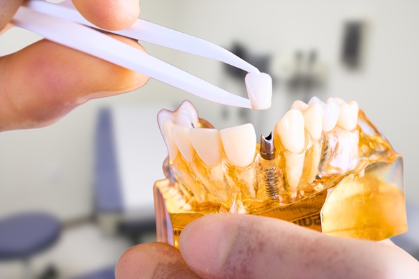 FAQs About Tooth Implants